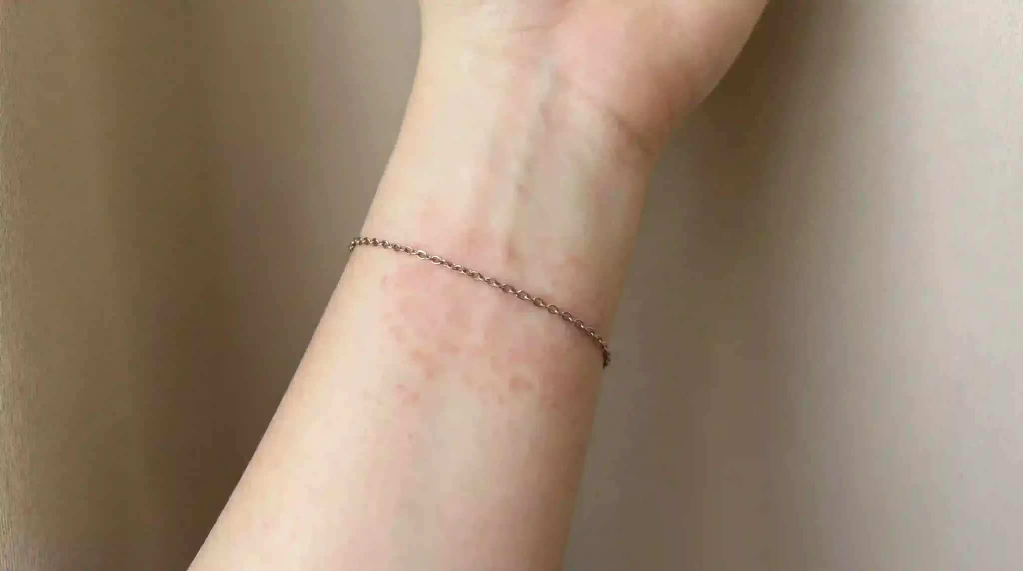 Image: Close-up of jewelry oxidation on skin
