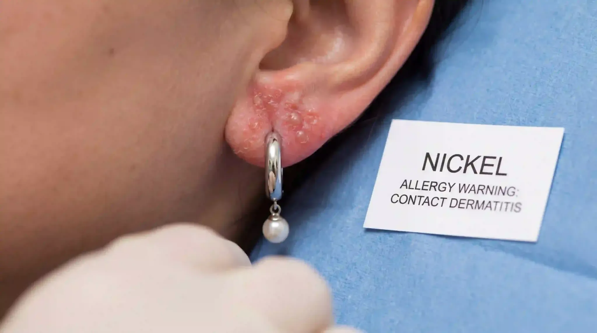 nickel allergy earring rash index 04096x2286